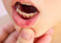 4 dấu hiệu răng miệng cảnh báo ung thư đang đến gần