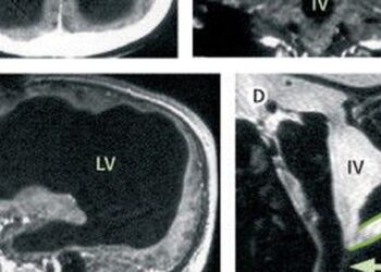 Kinh ngạc phát hiện người đàn ông gần như không có não, trong khoang sọ chỉ toàn chất lỏng vẫn sống bình thường: Nguyên nhân vì sao?