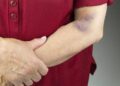 Bất kể nam hay nữ, nếu có 2 triệu chứng sau ở cánh tay thì có thể là ung thư, nên đi khám và điều trị càng sớm càng tốt